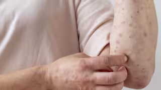 ¿En riesgo el Mundial 2026 en México por sarampión? Activan alerta epidemiológica.