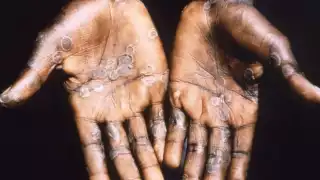 La viruela del mono es una padecimiento exantemático o eruptivo, muy parecido al herpes, asegura una académica de la Facultad de Medicina de la UNAM