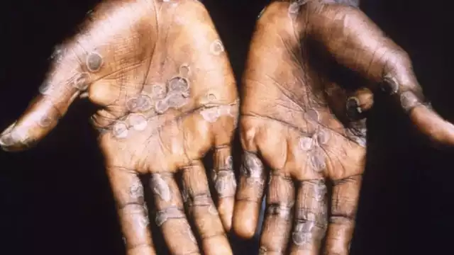 La viruela del mono es una padecimiento exantemático o eruptivo, muy parecido al herpes, asegura una académica de la Facultad de Medicina de la UNAM