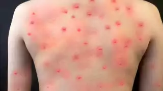 La viruela del mono se contrae por contacto físico y sexual. Foto: Especial