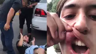 El alumno, identificado como Leonardo, mostró una de las heridas que registró luego de que fuese sometido por los elementos de seguridad de la UNAM