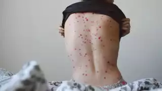 La viruela del mono llegó a México este 28 de mayo, pues fue un hombre de 51 años el portador de la enfermedad, que está siendo atendido en la CDXM