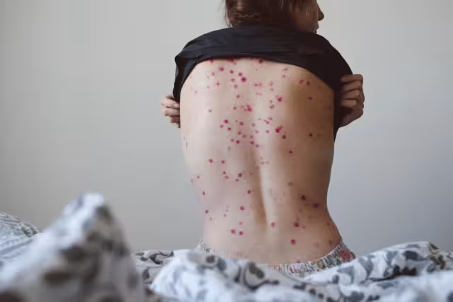 La viruela del mono llegó a México este 28 de mayo, pues fue un hombre de 51 años el portador de la enfermedad, que está siendo atendido en la CDXM