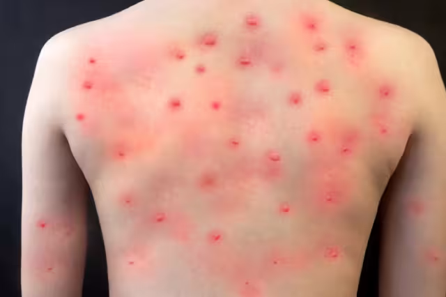 El primer caso de viruela del mono en Quintana Roo se dio a conocer este 18 de julio tras un comunicado del InDRE