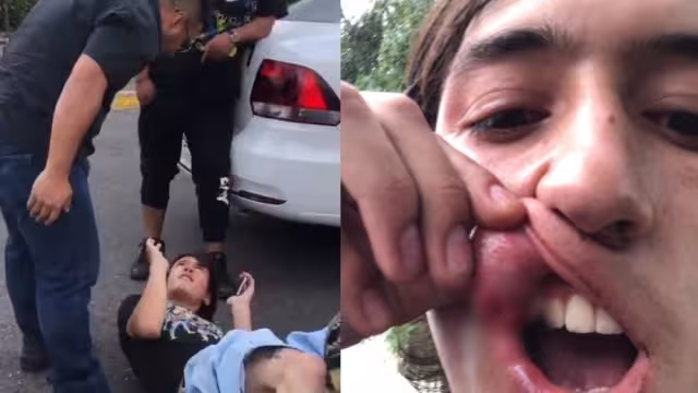 El alumno, identificado como Leonardo, mostró una de las heridas que registró luego de que fuese sometido por los elementos de seguridad de la UNAM