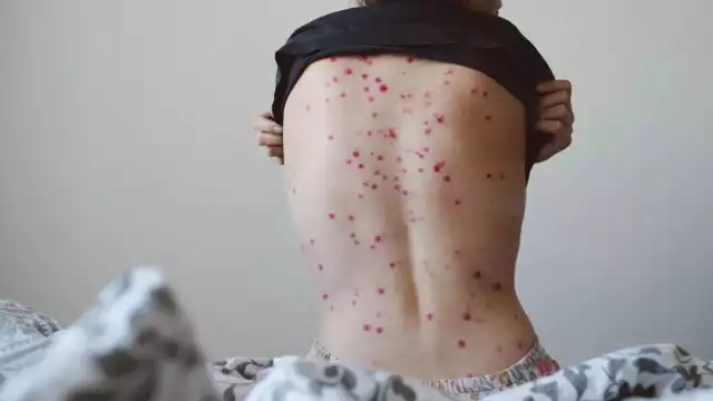 La viruela del mono llegó a México este 28 de mayo, pues fue un hombre de 51 años el portador de la enfermedad, que está siendo atendido en la CDXM