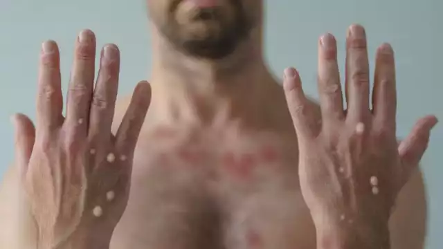 El aumento de contagios de la viruela del mono en Quintana Roo se dio a conocer este 13 de septiembre por medio de la SSA