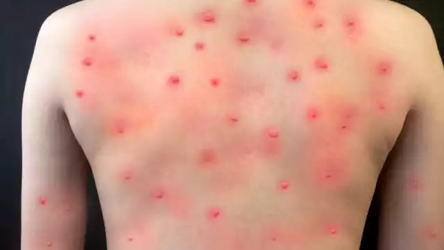 La viruela del mono se contrae por contacto físico y sexual. Foto: Especial