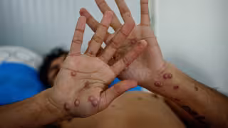 Confirman el primer caso de mpox de 2026 en Quintana Roo; esto se sabe