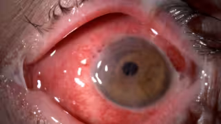 ¿Cómo saber qué tipo de conjuntivitis tengo? Estas son las diferencias entre la viral, bacteriana y alérgica