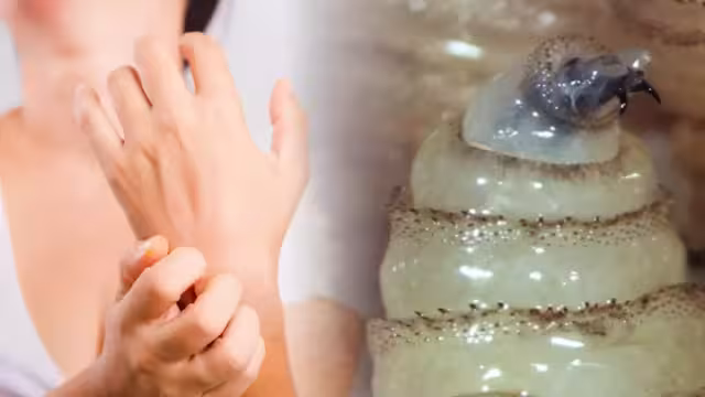 Nuevo paciente de 79 años hospitalizado por gusano barrenador