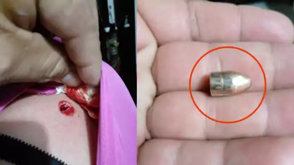 A la joven le extrajeron la bala en el IMSS-Bienestar de la ciudad de Champotón A la joven le extrajeron la bala en el IMSS-Bienestar de la ciudad de Champotón