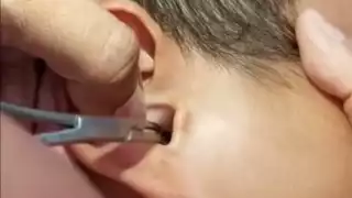 Encuentran una garrapata al interior del oído de un niño en Progreso