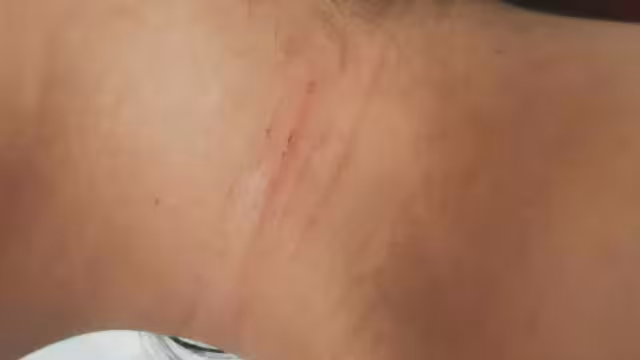 El maleante intentó despojarla de su ropa, dejándole rasguños