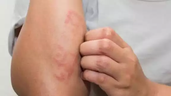 Este es uno de los síntomas de la lepra
