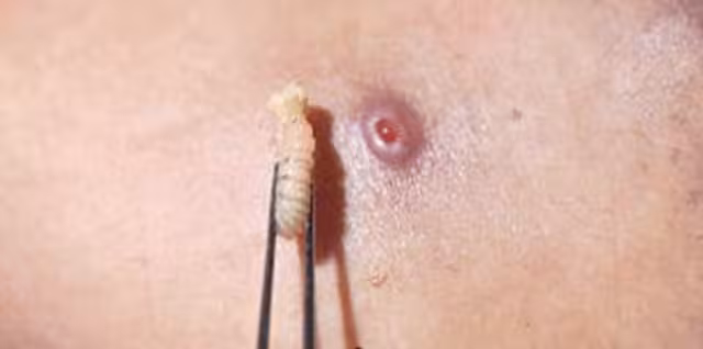 La Secretaría de Salud confirmó el noveno caso de Miasis por gusano barrenador en Campeche.