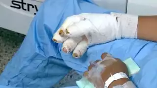 Tres niños heridos, saldo del uso de pirotecnia en Campeche; uno perdió tres dedos