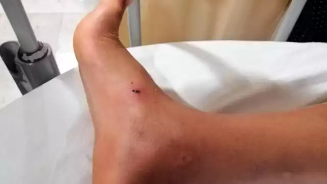 Las afectaciones se producen cuando los insectos o alimañas inoculan toxinas en el organismo y provocan una serie de alteraciones fisiopatológicas