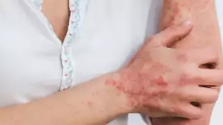 Casos de lepra en México