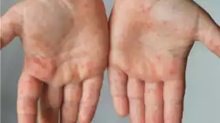 La persona se encuentra aislada, con tratamiento farmacológico y bajo atención médica, por lo que su estado de salud es estable.