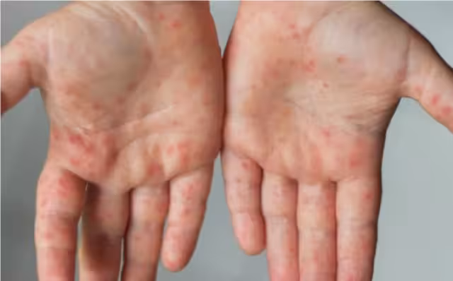 La persona se encuentra aislada, con tratamiento farmacológico y bajo atención médica, por lo que su estado de salud es estable.