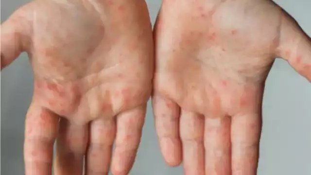 La persona se encuentra aislada, con tratamiento farmacológico y bajo atención médica, por lo que su estado de salud es estable.