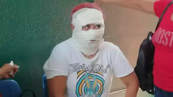 La mujer sufrió quemaduras en la cara y en las manos.