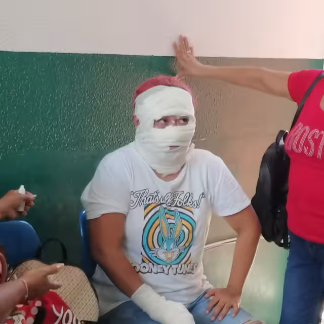 La mujer sufrió quemaduras en la cara y en las manos.