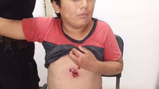 Otro de los niños resultó con heridas tras intentar prender una "palomita"