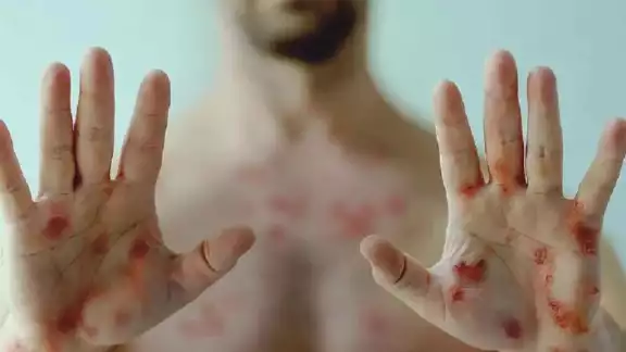 Hasta el momento no hay reporte de que haya algún enfermo de mpox en Yucatán Hasta el momento no hay reporte de que haya algún enfermo de mpox en Yucatán
