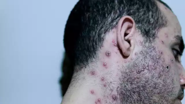 El segundo caso de la viruela del mono en Quintana Roo se dio a conocer este 09 de agosto por medio de la SSA