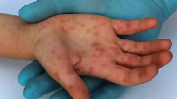 La viruela del mono, que no suele ser mortal, puede causar fiebre, dolores de cabeza, musculares o de espalda, ganglios linfáticos inflamados, escalofríos y fatiga La viruela del mono, que no suele ser mortal, puede causar fiebre, dolores de cabeza, musculares o de espalda, ganglios linfáticos inflamados, escalofríos y fatiga
