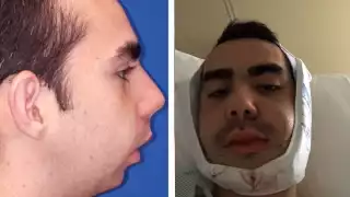 Usuario de TikTok realiza nueve cirugías en su rostro y muestra el increíble resultado