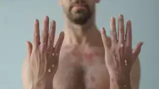 El aumento de contagios de la viruela del mono en Quintana Roo se dio a conocer este 13 de septiembre por medio de la SSA