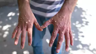 Registra México mil 968 casos de viruela símica: Secretaría de Salud