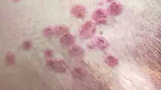 El segundo caso de la viruela del mono en Quintana Roo se dio a conocer este 02 de agosto por medio de la SSA