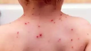 Casos de varicela se disparan en Campeche; hay más contagios en hombres que mujeres