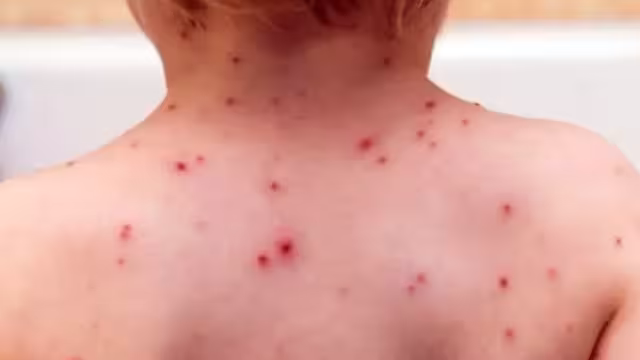 En menos de tres meses suman 132 contagios; en 2024 se registraron solo 84 en todo el año