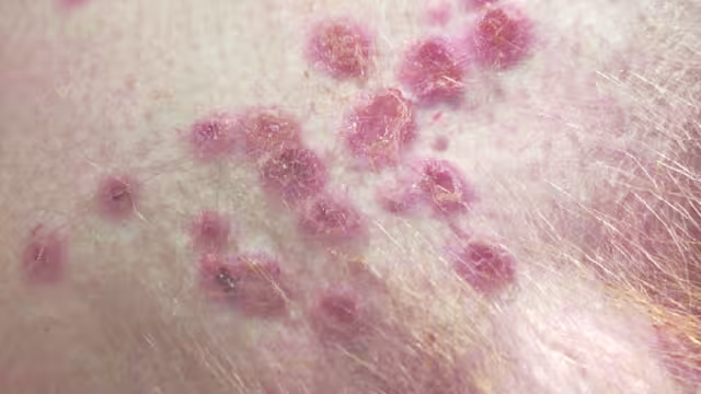 El segundo caso de la viruela del mono en Quintana Roo se dio a conocer este 02 de agosto por medio de la SSA