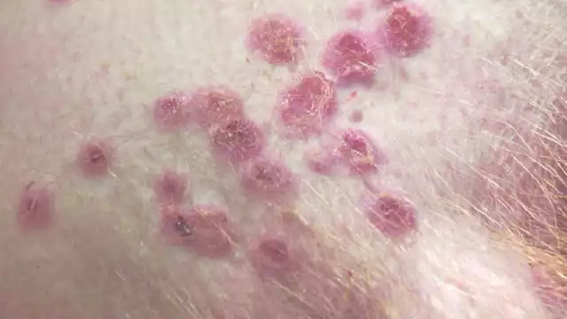 El segundo caso de la viruela del mono en Quintana Roo se dio a conocer este 02 de agosto por medio de la SSA