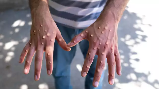 Registra México mil 968 casos de viruela símica: Secretaría de Salud