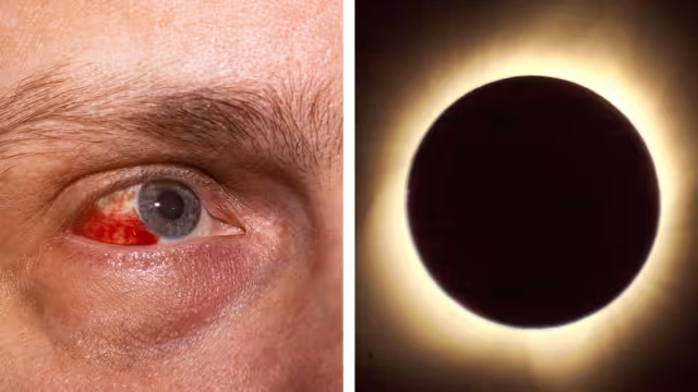 Internautas reportan sufrir daños en las pupilas tras el eclipse solar