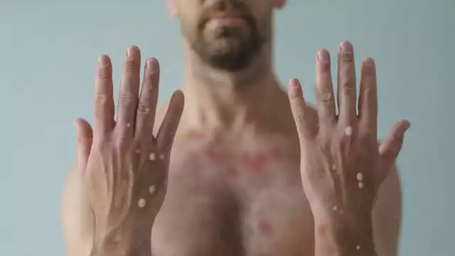 El aumento de contagios de la viruela del mono en Quintana Roo se dio a conocer este 13 de septiembre por medio de la SSA