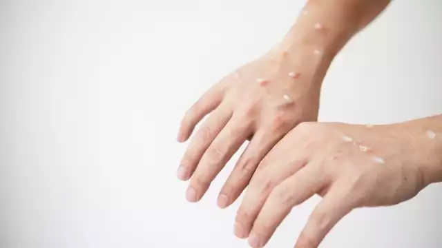 Se registraron 10 nuevos casos de viruela del mono en Yucatán