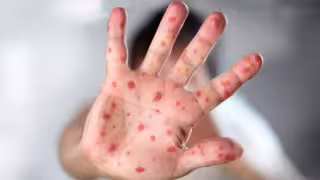 En semanas, Yucatán pasa de 1 a 10 casos de sarampión: así avanza la enfermedad en la región