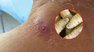 Secretaría de Salud confirma segundo caso de miasis por gusano barrenador en  un hombre en Yucatán