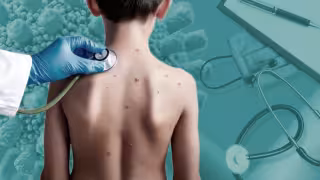 “Una persona puede contagiar a su familia, y a los vecinos”; ¿por qué es más contagioso el sarampión que el Covid 19?