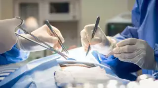   Pediatra yucateco opera con éxito a una niña de 3 años con Síndrome de Rapunzel  