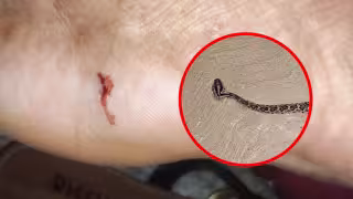 Mujer es hospitalizada tras ser mordida por una serpiente de cascabel en Mérida