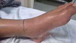 Tizimín suma  dos casos de mordedura de serpiente de cascabel; uno fue una niña de 11 años